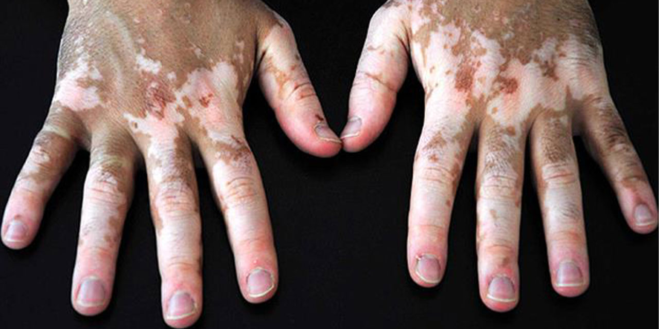 Vitiligo belirtileri nedir? Vitiligo neden olur?