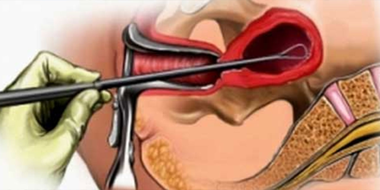 Чистка вакуумом после родов. Пайпель-биопсия эндометрия. Выскабливание полости матки при эндометриозе. Выскабливание цервикального канала шейки.