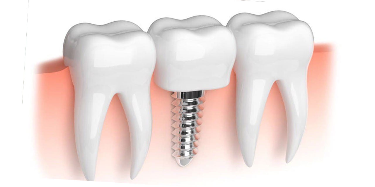 İmplant nedir nasıl yapılır?
