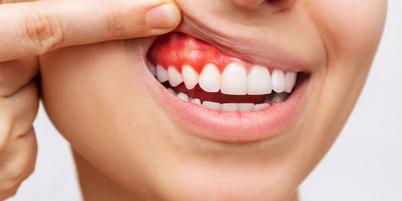 Periodontoloji nedir? Periodontoloji nasıl tedavi edilir?