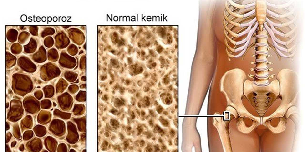 Osteoporoz nedir? Osteoporoz belirtileri nelerdir?