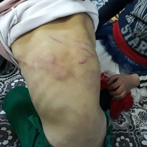 Suriyeli çocuğun babası tarafından dövüldüğü ortaya çıktı