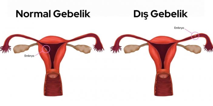 dis-gebelik-nedir-1.jpg